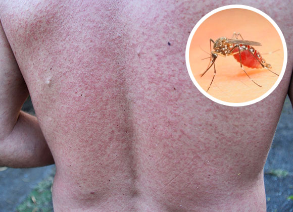 8 cosas que puedes hacer para protegerte del virus zika