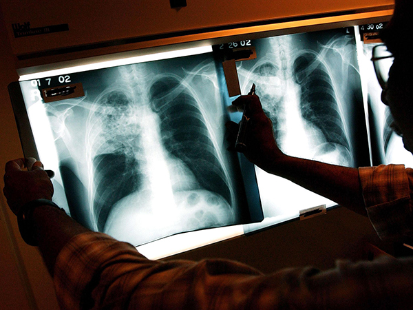 Descubren un nuevo caso  de tuberculosis en El Piache
