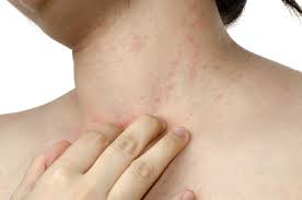 Aumentan casos de psoriasis y hongos por mala higiene de la piel