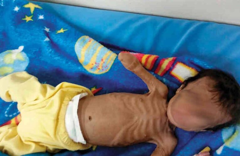 Unicef reportó aumento de la desnutrición aguda en el país