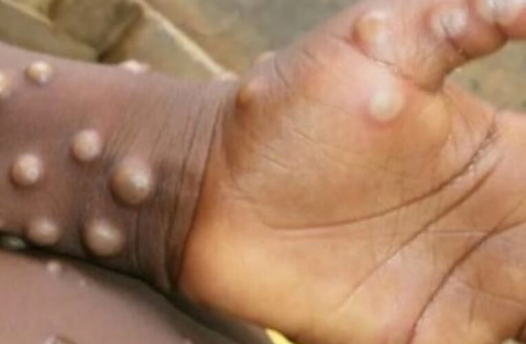 Médicos piden cortar cadena de transmisión de la viruela del mono