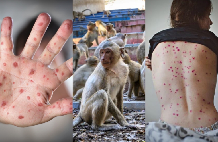 203 casos de viruela del mono en Perú