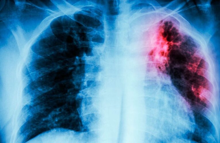 Reportan 11 mil casos de tuberculosis en el país