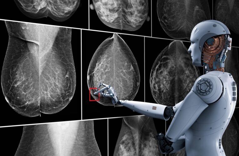 La inteligencia artificial se abre camino en la lucha contra el cáncer de mama