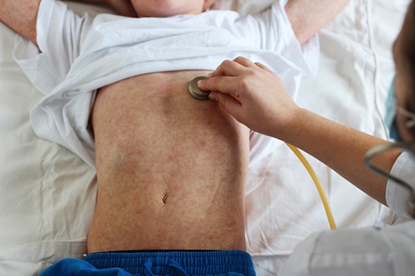OPS pide incrementarlas coberturas de vacunación para sarampión
