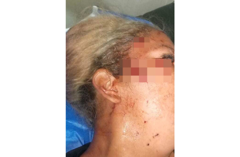 Mujer trabajadora de playa San Luis fue herida en el rostro por usuario