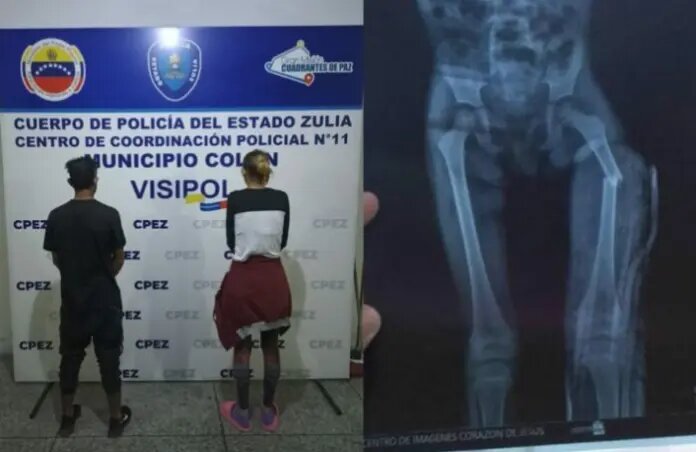 La madre y su pareja le fracturaron una pierna a niña de 3 años
