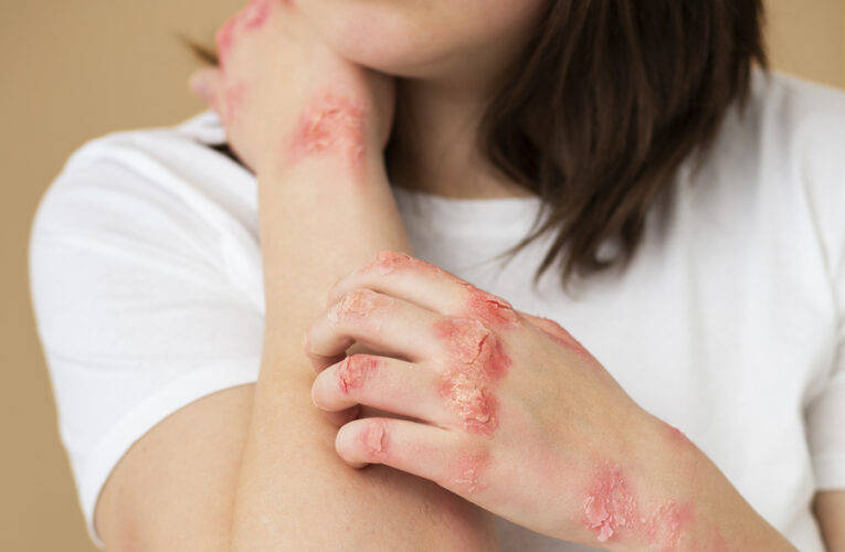 Se disparan la dermatitis seborreica y la psoriasis por el estrés