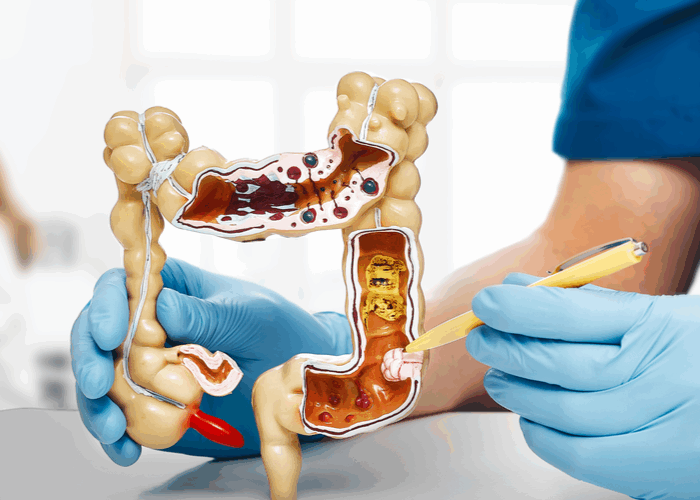 ¿Cáncer colorrectal a los 40? Sí