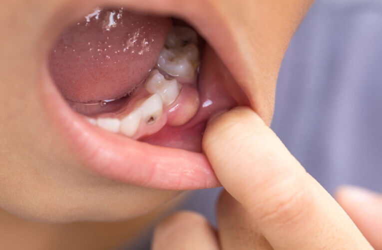 Alimentos ultraprocesados amenazan la salud dental de los niños